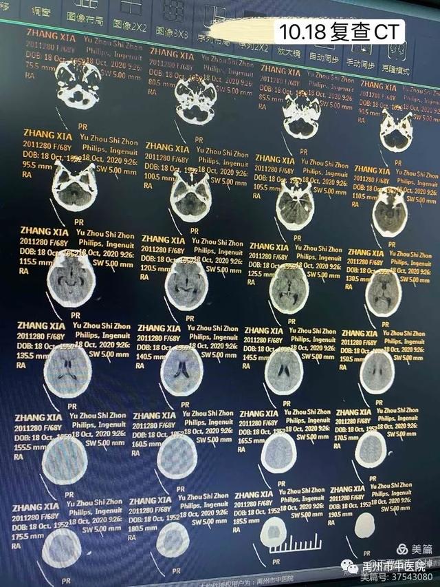 禹州市中医院重症医学科成功开展颅内动脉瘤介入栓塞手术! 禹州市中医院重症医学科成功开展颅内动脉瘤介入栓塞手术!