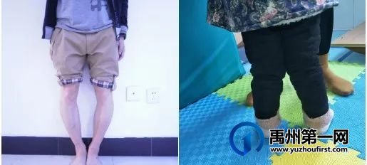 禹州市人民医院儿童康复暑期形体矫治训练班开始啦! 禹州市人民医院儿童康复暑期形体矫治训练班开始啦!