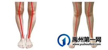 禹州市人民医院儿童康复暑期形体矫治训练班开始啦! 禹州市人民医院儿童康复暑期形体矫治训练班开始啦!